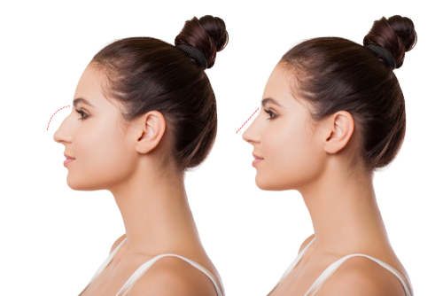 Mediguide Istanbul: Rhinoplasty Procedures  - Downward Pointing Tip Correction