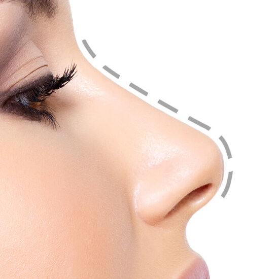 Mediguide Istanbul: Rhinoplasty Procedures  - Tip Correction